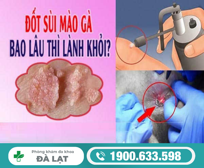 ĐIỀU TRỊ SÙI MÀO GÀ BAO LÂU THÌ KHỎI HOÀN TOÀN?